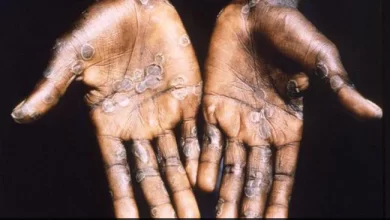 Photo of Monkeypox virus बना दुनिया के लिए खतरा, USA में एक मामले की पुष्टि