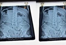 Photo of अम्बेडकरनगर में हैरान करने वाला मामला: नशे में युवक ने प्राइवेट पार्ट में डाली बोतल, दर्द से अस्पताल भागा